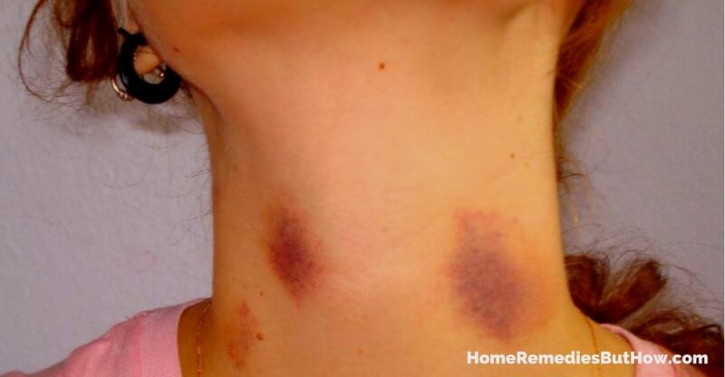 Hickies Fast Naturally