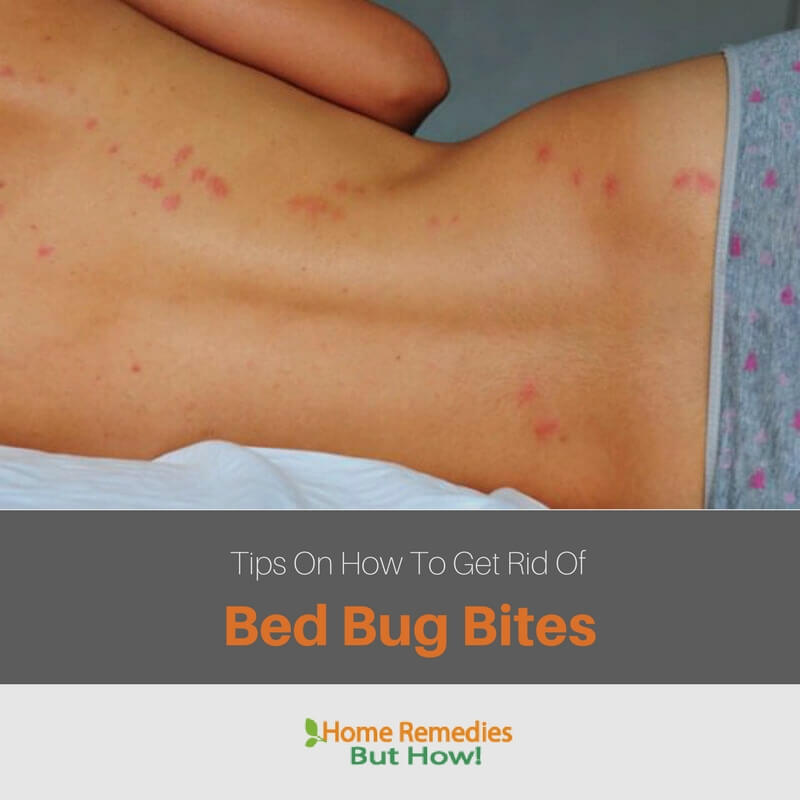 How To Get Rid Of Bed Bug Bites