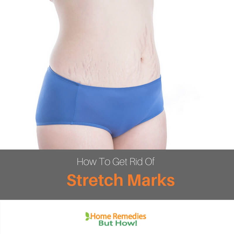 How to Get Rid of Stretch Marks