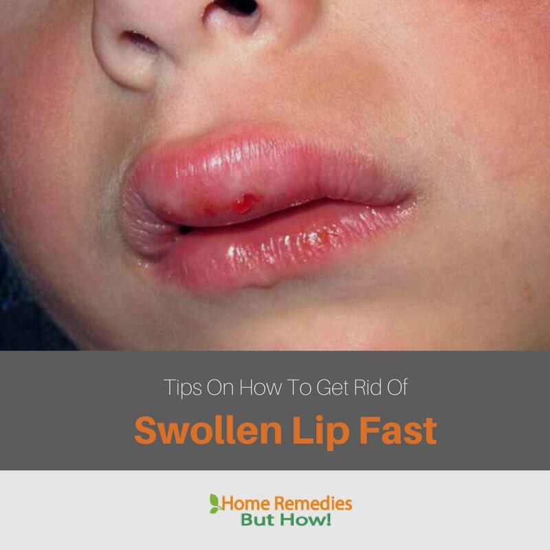How to get rid of a swollen lip fast